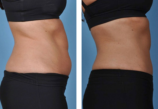 Coolsculpting Results