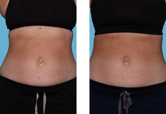 Ultimate Contour NYC  Nonsurgical Body Contouring NYC